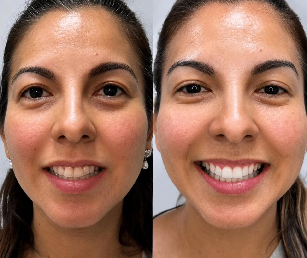 Registro fotográfico comparativo de una sonrisa, caso 1